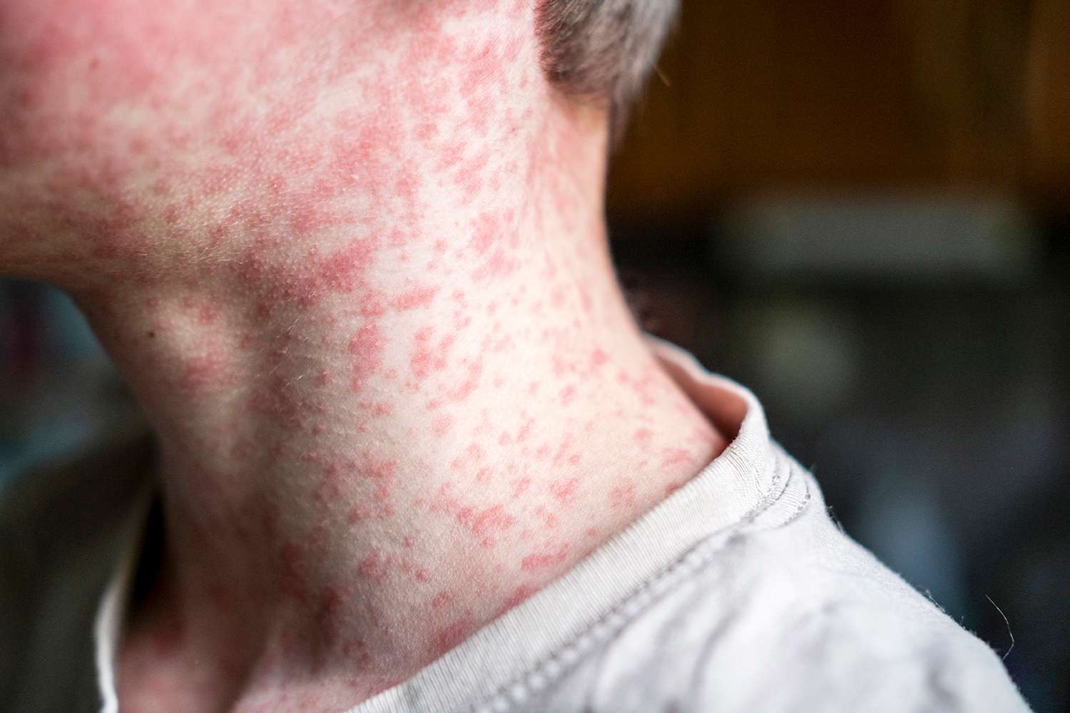 Measles Outbreak 2026